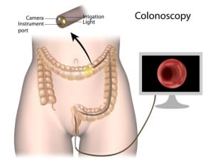 Common Tests in General Practice: Colonoscopy