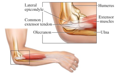 Common Issues in General Practice: Tennis Elbow