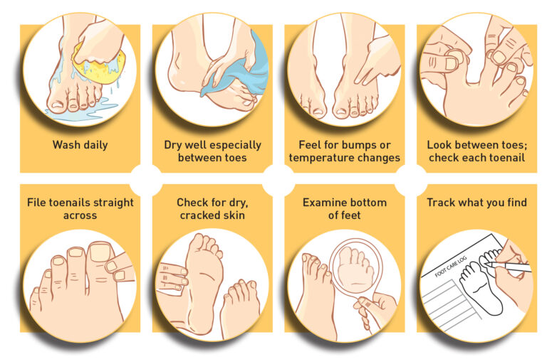 Foot care for people with Diabetes