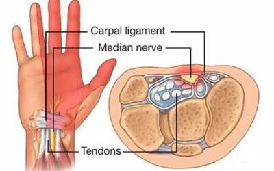 Common Issues in General Practice: Carpal Tunnel Syndrome