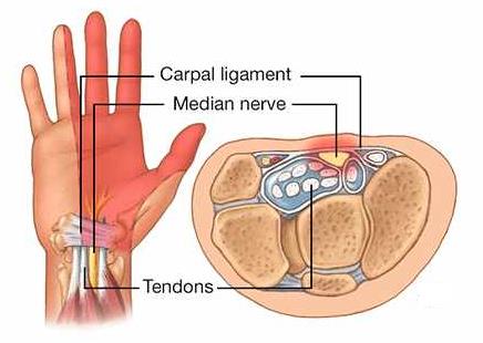 Common Issues in General Practice: Carpal Tunnel Syndrome